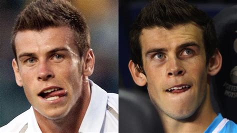 gareth bale ears|gareth bale ear surgery.